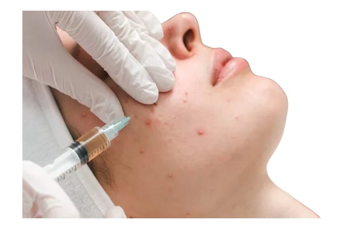Acne Treatment Write For Us
